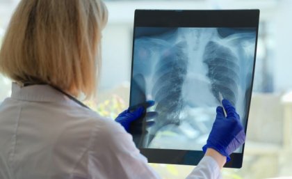 A person in a white coat looks at an xray of a rib cage and lungs.